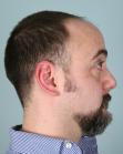 Before Hair Transplant&nbsp;Front